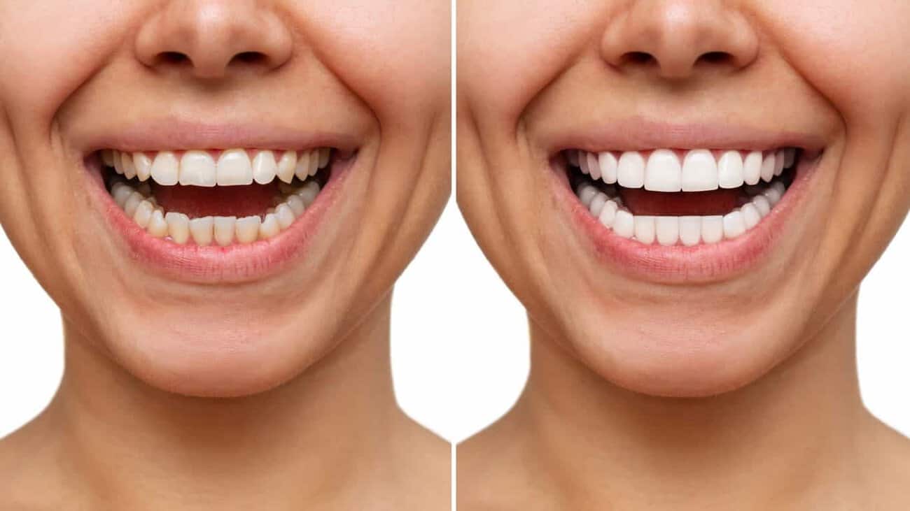 Can Laser Whitening Be Done on Teeth with Fillings or Crown Littlehampton