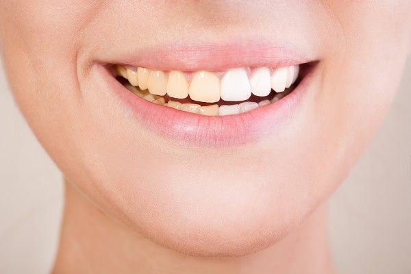 Can Laser Whitening Target Specific Types of Stains Better Than Strips Littlehampton