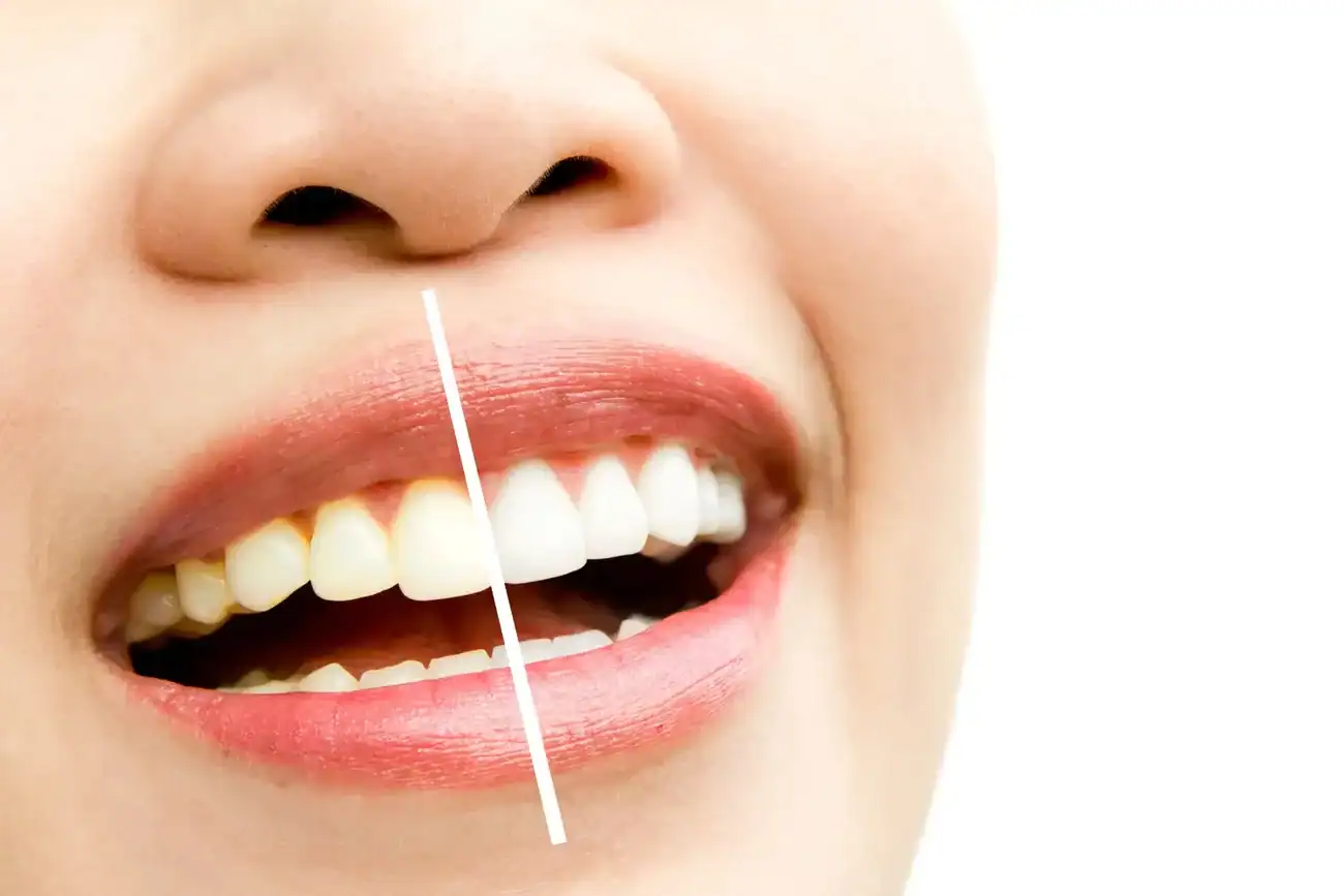 Can Laser Whitening Fix Uneven Tooth Discolouration Littlehampton